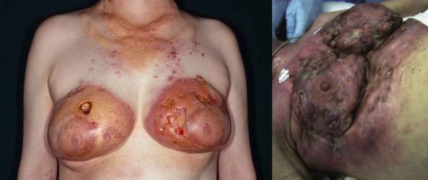 Ответная реакция кожи на введение силикона в грудь