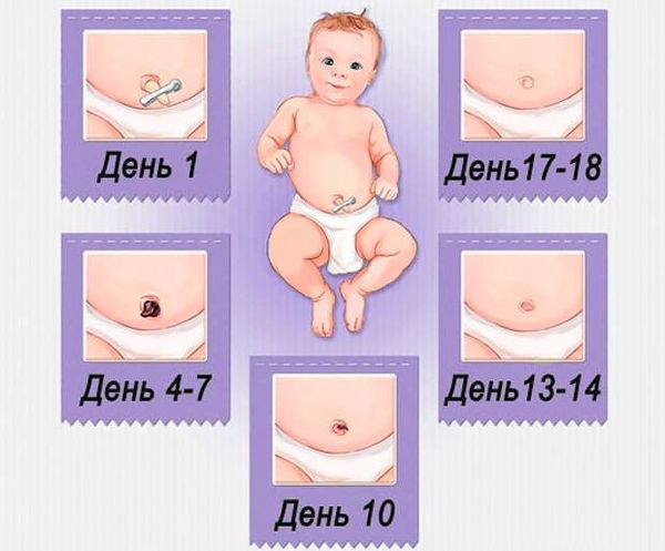 Заживление пуповины