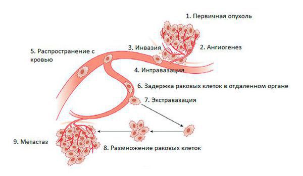 Метастазирование