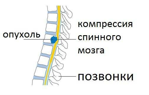 Компрессия спинного мозга