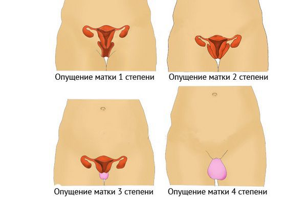 Стадии опущения матки
