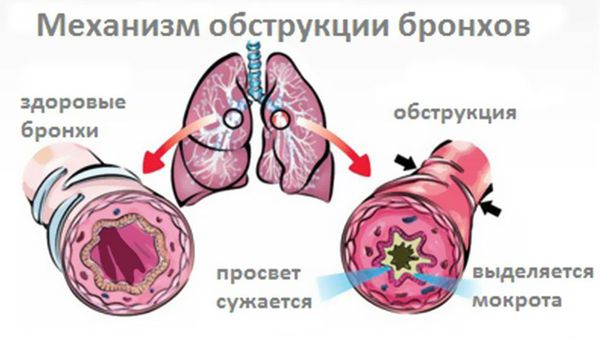 Обструкция бронхов