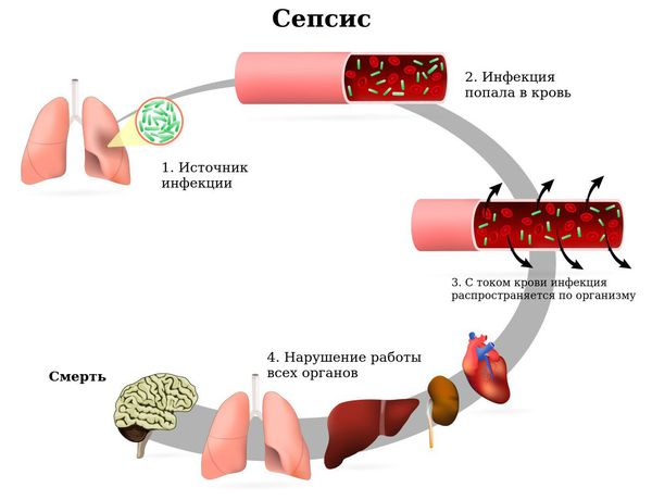 Сепсис
