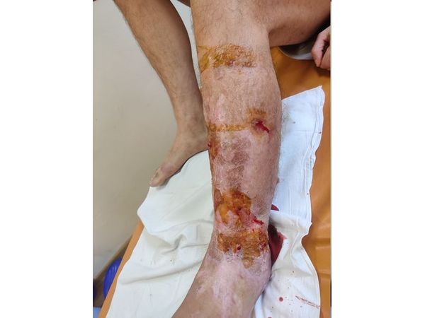 Голень после демонтажа аппарата Илизарова