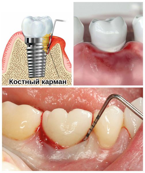 Ранние признаки периимплантита
