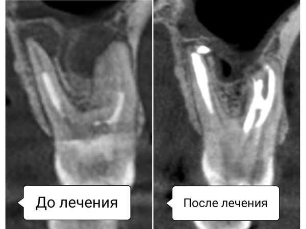 Зуб 2.6 до и после лечения