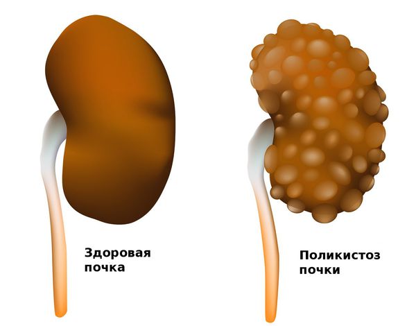 Здоровая почка и почка с поликистозом