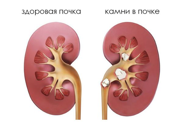 Камни в почках