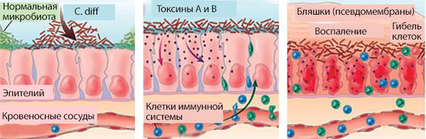 Патогенез ПМК
