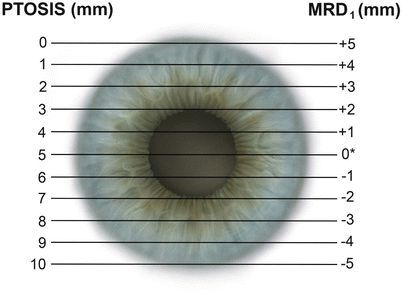 MRD-показатель