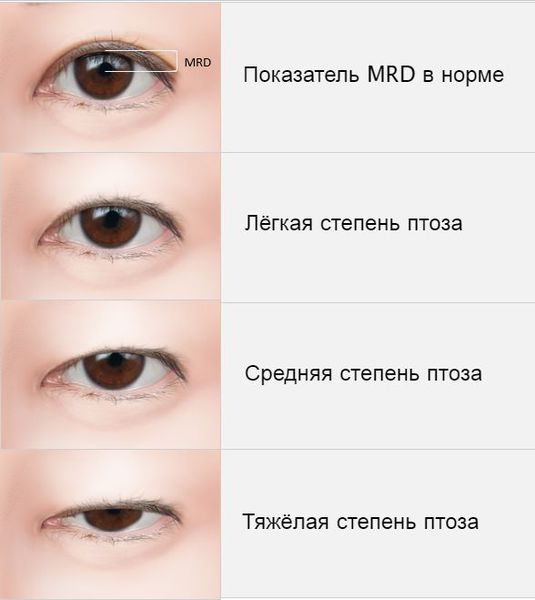 Степени тяжести блефароптоза
