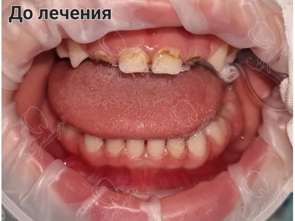 До лечения