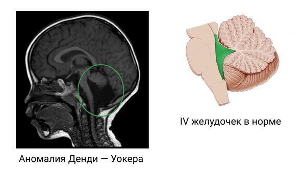 Расширение четвёртого желудочка при аномалии Денди — Уокера 
