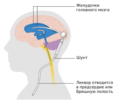 Вентрикулярное шунтирование