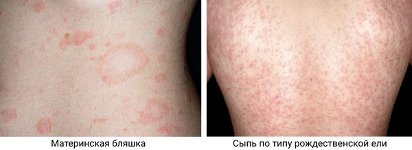 Материнская бляшка и "рождественская ель" 