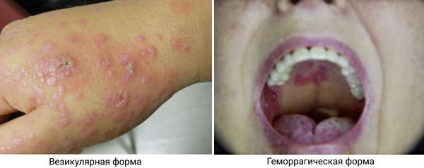 Везикулярный и геморрагический розовый лишай 