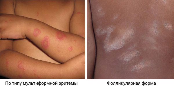 Розовый лишай по типу мультиформной эритемы и фолликулярный розовый лишай 