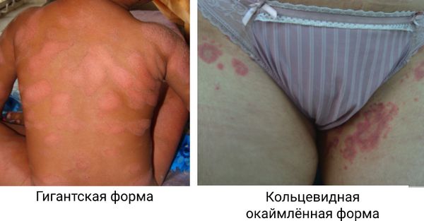 Гигантский розовый лишай Дарье и розовый лишай Видаля 