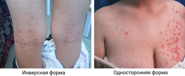 Инверсивный и односторонний розовый лишай 