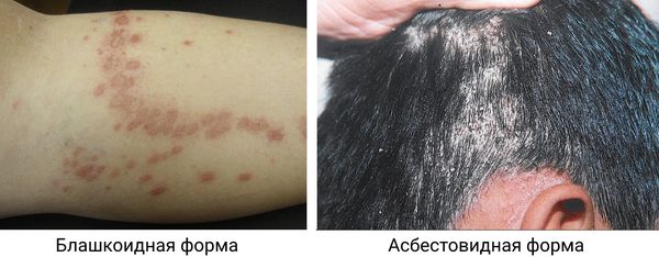 Блашкоидный и асбестовидный розовый лишай 