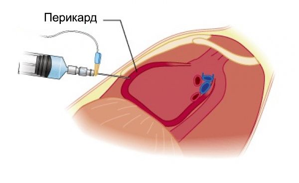 Перикардиоцентез