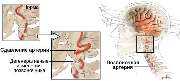 Сдавление позвоночной артерии