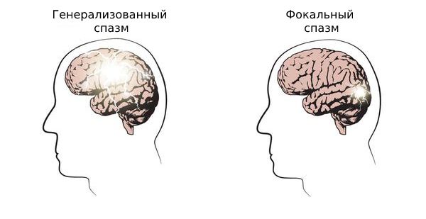 Виды спазмов
