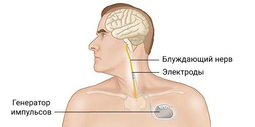 Имплантация стимулятора блуждающего нерва