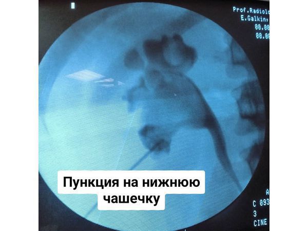 Этап операции: перкутанная нефролитолапаксия слева