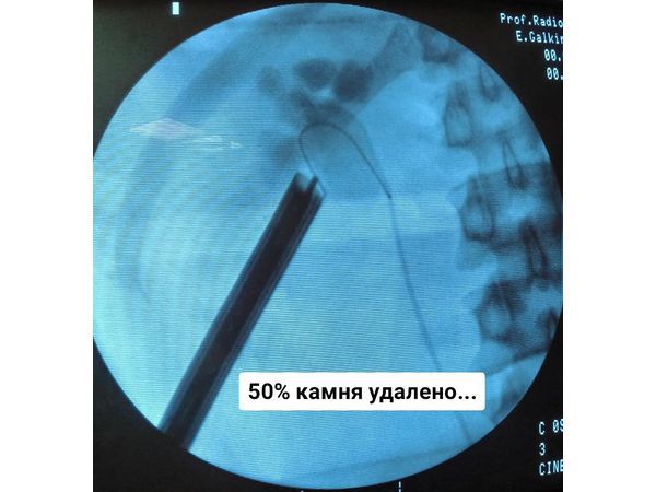 Этап операции: 50% камня удалено
