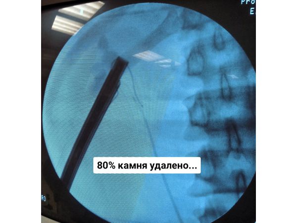 Этап операции: 80% камня удалено