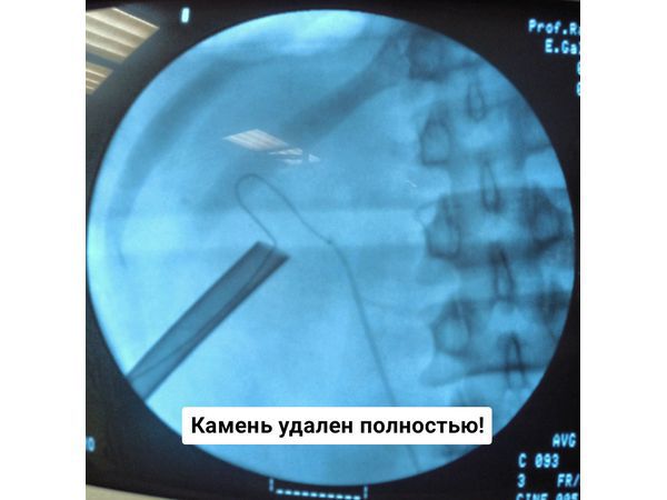 Завершение операции: камень удалён полностью, установлен нефростомический дренаж