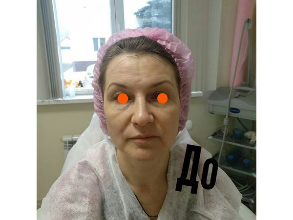 Фото пациентки до лифтинга