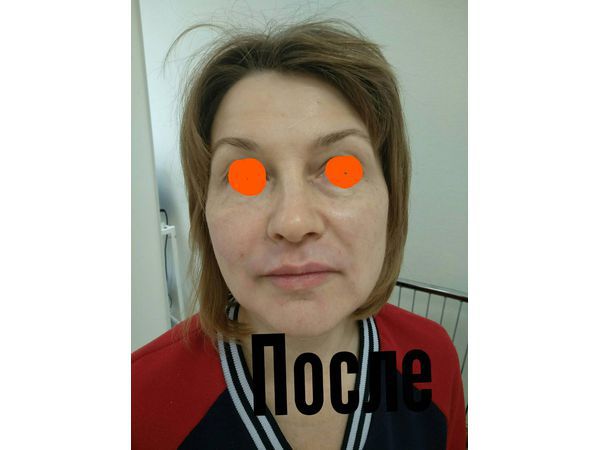 Эффект лифтинга кожи с помощью нитей изподиаксонона и жидких нитей с биозолотом