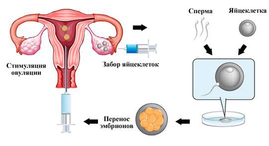 Стимуляция овуляции