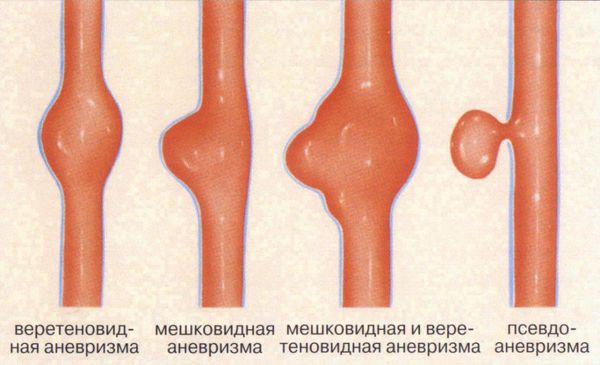 Аневризмы