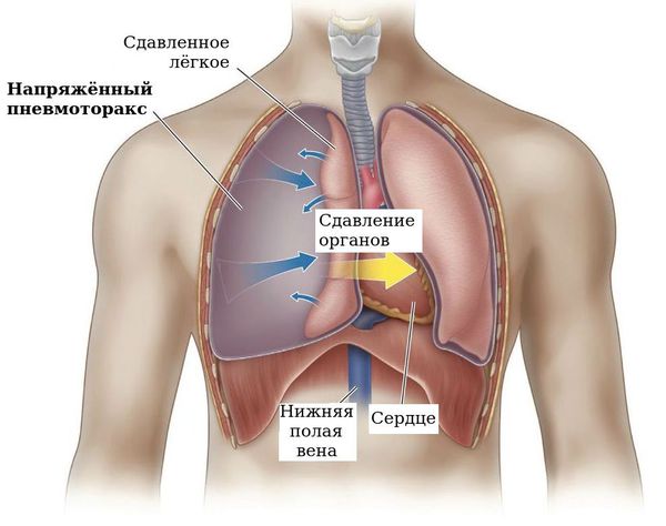 Напряжённый пневмоторакс