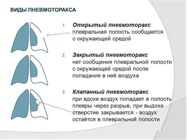 Виды пневмоторакса по механизму