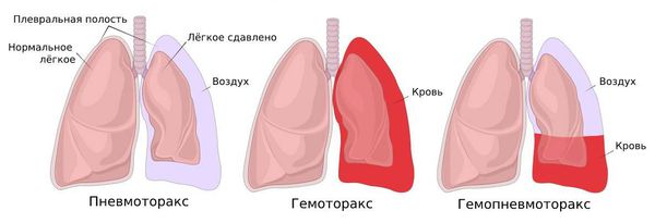 Пневмоторакс, гемоторакс, гемопневмоторакс