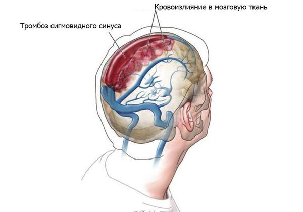 Тромбоз сигмовидного синуса