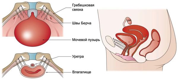 Кольпосуспензия Берча
