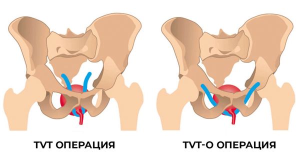TVY и TVT-O операции