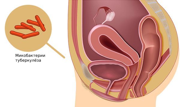 Туберкулёз женских половых органов