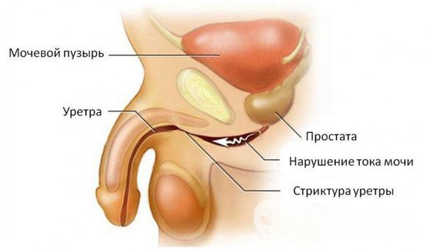 Стриктуры уретры