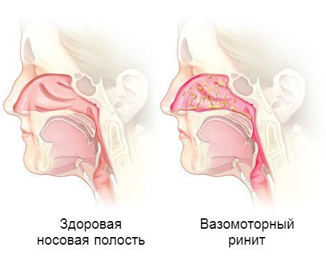 Обильное выделение слизи в носовой полости