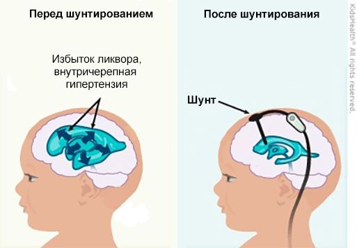Шунтирование