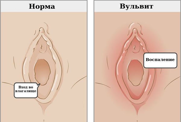 Воспаление вульвы