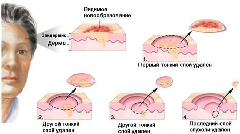 Техника MOHS